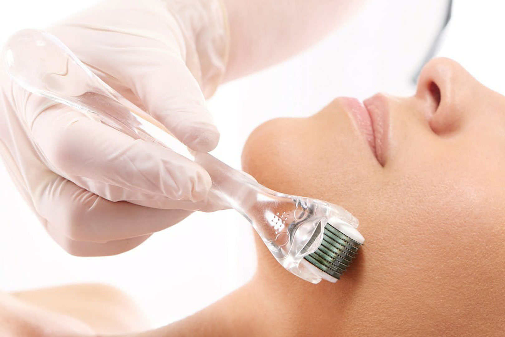 Microneedling-(aka-collagen-induction-therapy)